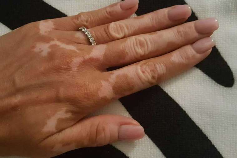 vitiligo